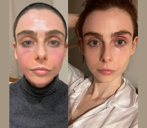 Radiofrequency (RF) Microneedling in dubai