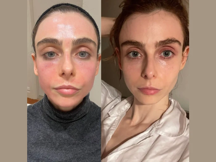 Radiofrequency (RF) Microneedling in dubai