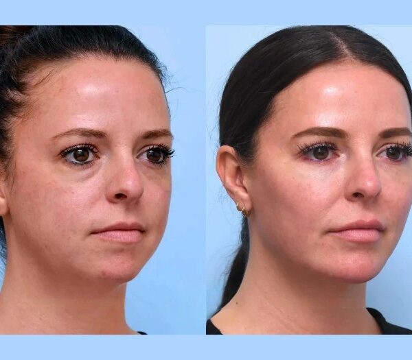 Best Doctors in Dubai Perfect Facial Lifting With Safe Thread Lift Methods