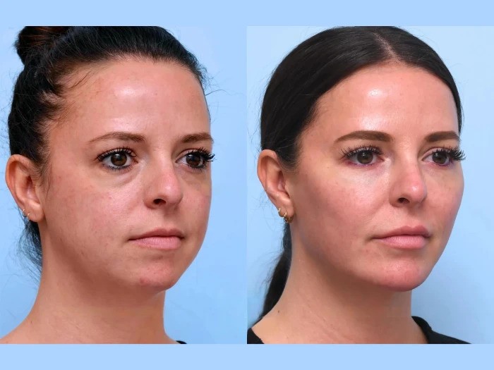Best Doctors in Dubai Perfect Facial Lifting With Safe Thread Lift Methods