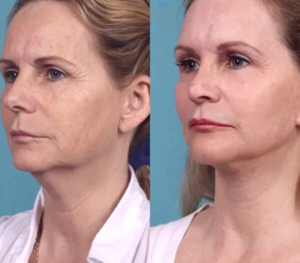 Chemical Peel Treatment in dubai