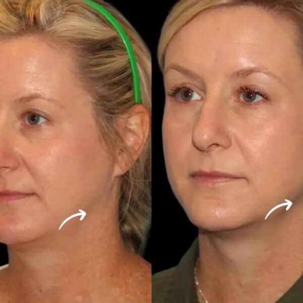 sculptra fillers in dubai