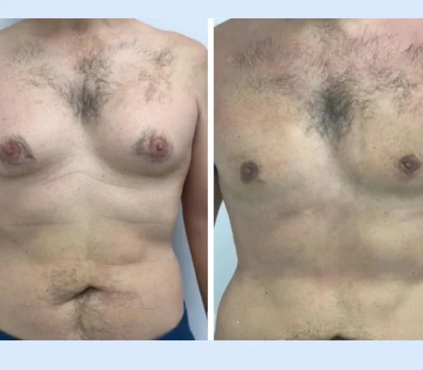 Gynecomastia in Dubai