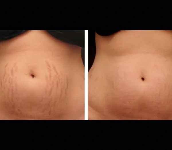 Radiofrequency (RF) Microneedling in dubai