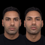 How Jawline Fillers Enhance Facial Symmetry at the Best Aesthetic Clinics in Dubai