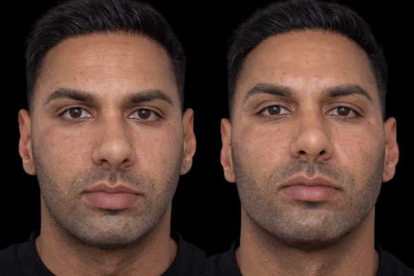 Jawline Fillers in Dubai