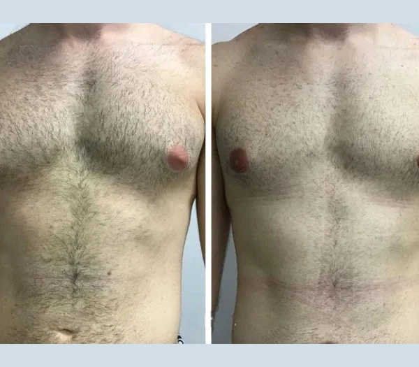 Gynecomastia in Dubai