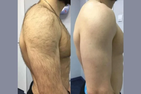 Electrolysis Laser hair removal in dubai