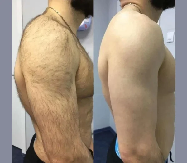 Electrolysis Laser hair removal in dubai