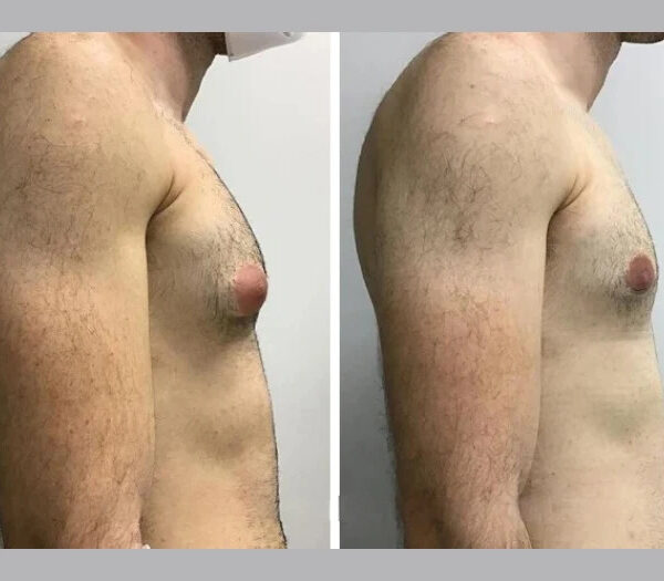 gynecomastia in dubai