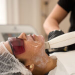 Laser for Rosacea in London: Targeted Laser Care to Calm Redness and Sensitivity