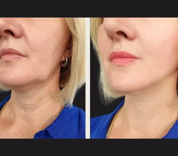 PRP Treatment in Dubai