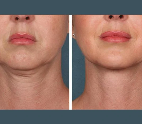 PRP Treatment in Dubai