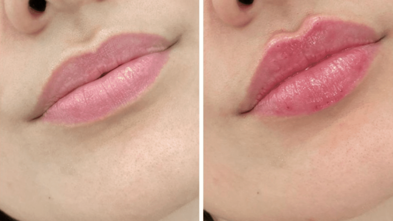 Juvederm Fillers for Chin Enhancement: The Non-Surgical Solution at the Best Aesthetic Clinics in Dubai