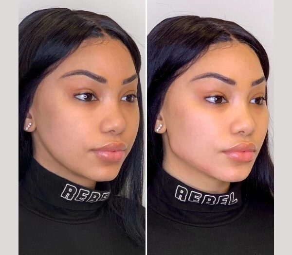 Best Aesthetic Clinics in Dubai Offering Celebrity-Level Thread Lift