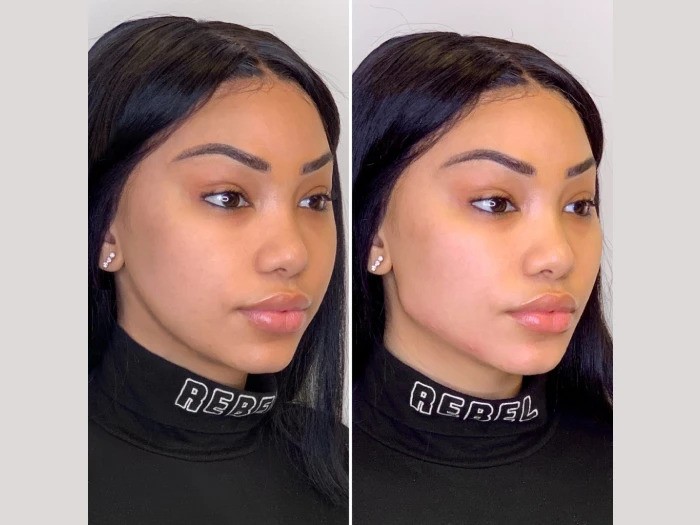 Best Aesthetic Clinics in Dubai Offering Celebrity-Level Thread Lift