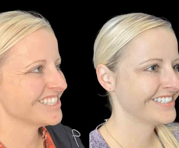 Achieve a Refreshed, Youthful Look with the Best Doctors in Dubai for Botox