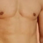 شفط الدهون في جدة لنحت الجسم واستعادة التناسق