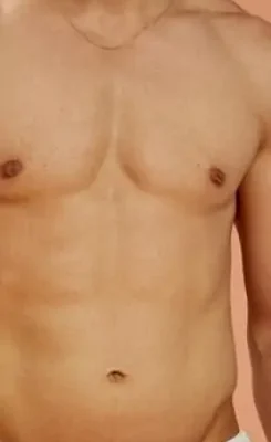 شفط الدهون في جدة لنحت الجسم واستعادة التناسق