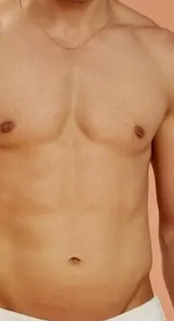 شفط الدهون في جدة لنحت الجسم واستعادة التناسق