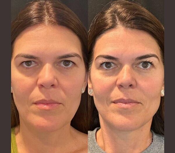 Best Plastic Surgeon in Dubai Choose Thread Lift for Subtle Anti-Aging