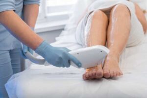 laser hair removal in Bristol