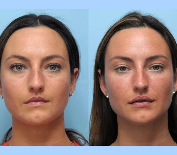 Best Doctors in Dubai for Thread Lift Non-Surgical, Age-Defying Facial Rejuvenation